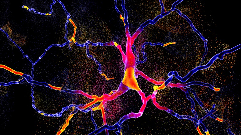 Degeneration of dopaminergic neuron, a key stage of development of Parkinson's disease, 3D illustration - Illustration 